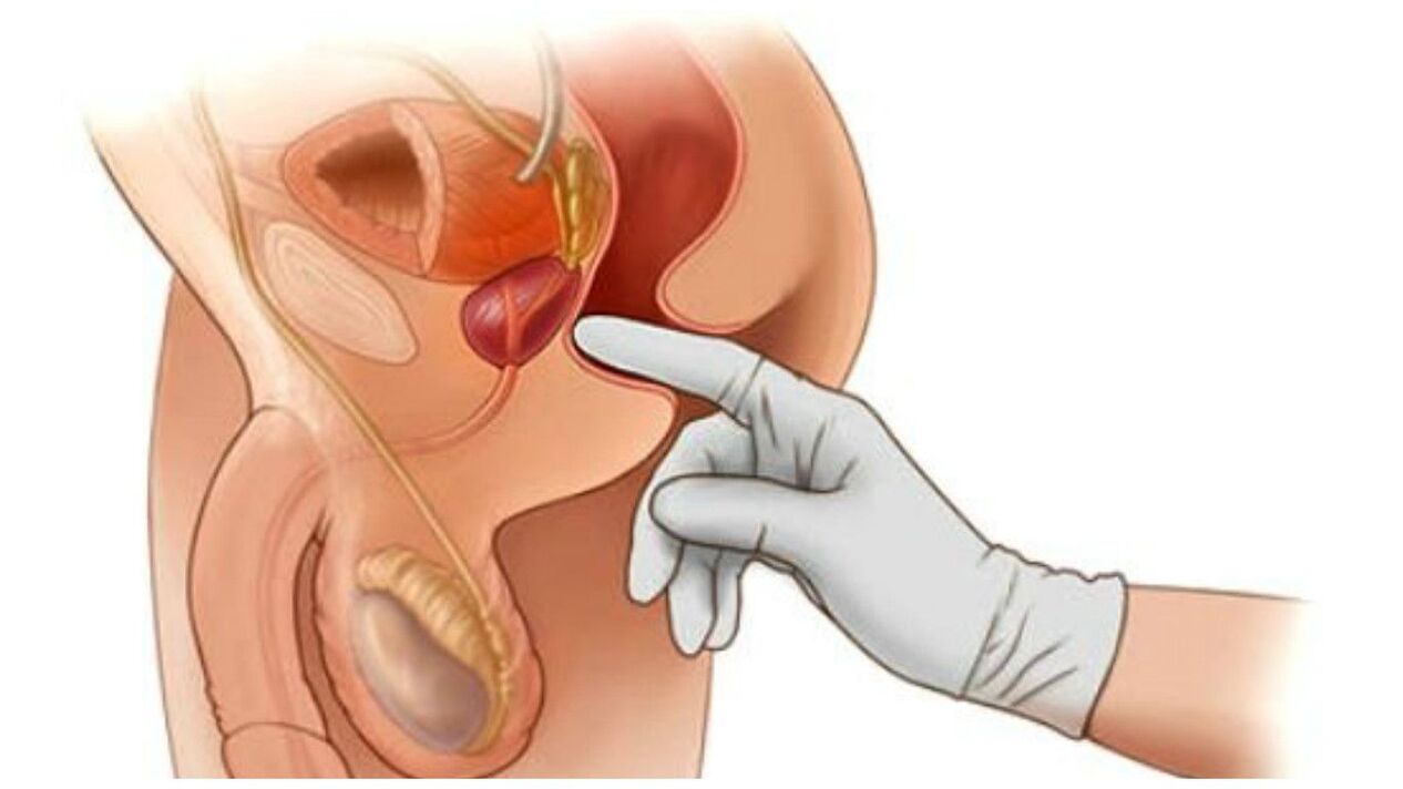 prostatas masāža