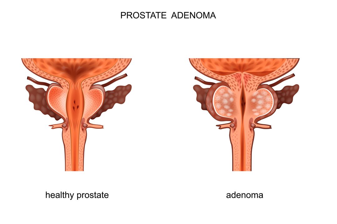 Veselīga prostata un adenoma