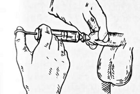 instilācijas prostatīta ārstēšanai
