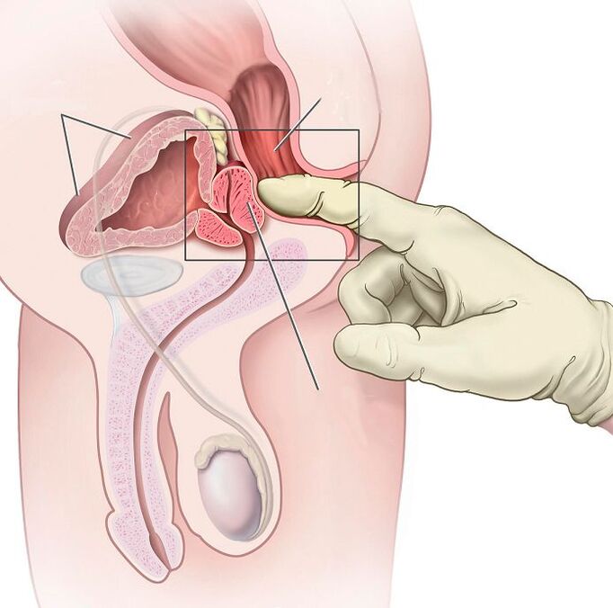 Prostatas masāža prostatīta ārstēšanai