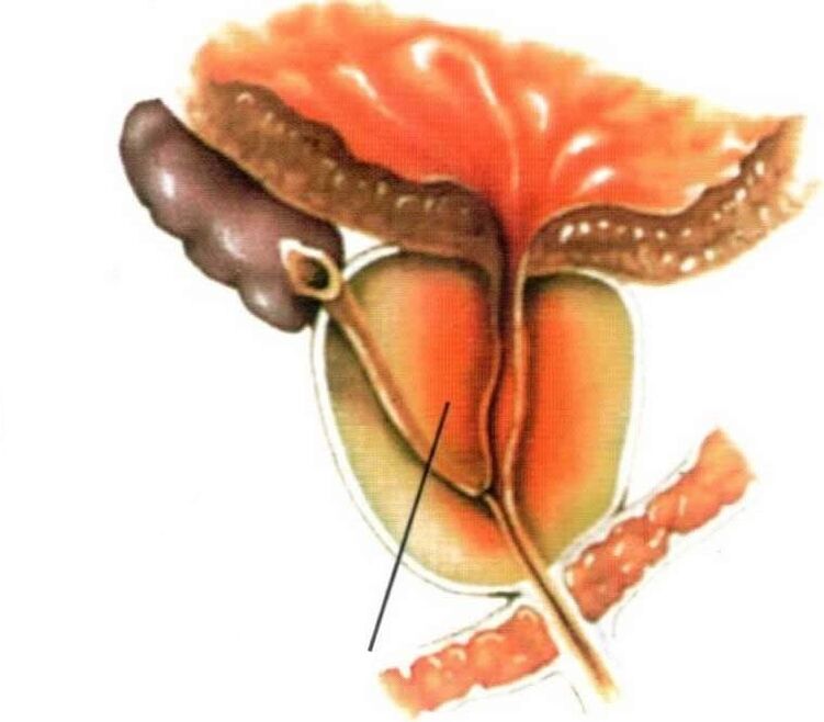 Prostatas audu iekaisums hroniska prostatīta gadījumā